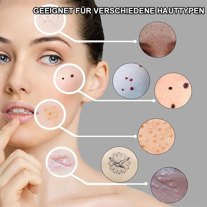 Laserbehandlung-Stift Blu-Ray unerwünschte Akne entfernen